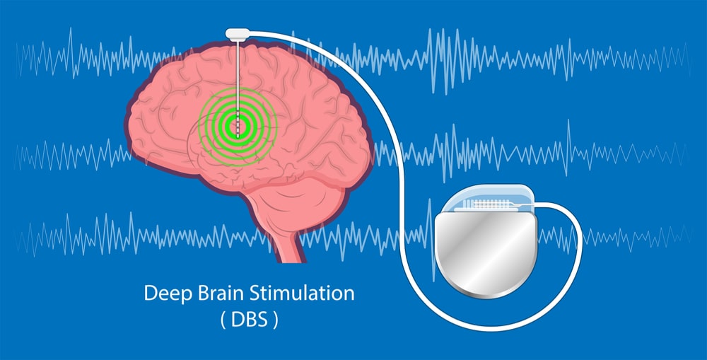 Issues with Deep Brain Stimulation for Depression